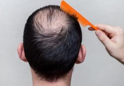ریزش مو در طب سنتی